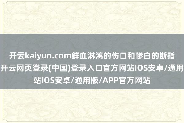 开云kaiyun.com鲜血淋漓的伤口和惨白的断指让家属几近崩溃-开云网页登录(中国)登录入口官方网站IOS安卓/通用版/APP官方网站